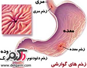 زخم معده