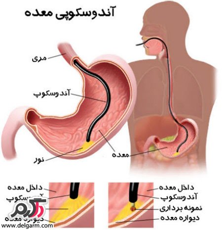 علائم زخم معده