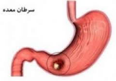 آیامیتوان از سرطان معده پیشگیری کرد؟ (2 نکته مهم)