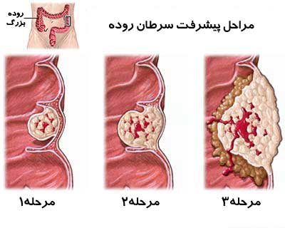 قاتل خاموش و مرگباری بنام سرطان روده! (2 نکته مهم)