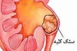 مبتلايان به سنگ کليه، گریپ فروت بخورند یا نخورند؟