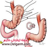 پلیسه معده