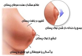 علل و راههای پیشگیری از سرطان سینه