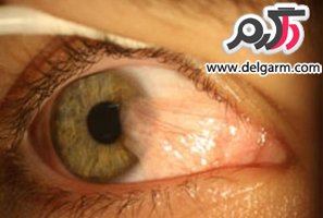 ناخنک چشم (تریژیوم) چیست و راه درمان آن چگونه است؟ (2 نکته مهم)