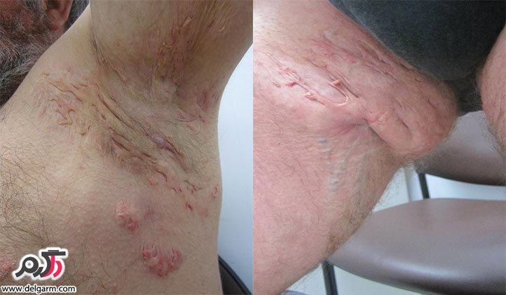 هیدرآدنیت چرکی