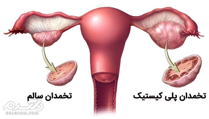 تقویت تخمدان