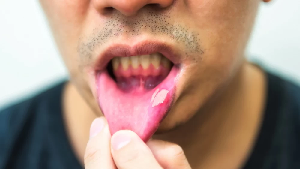 علل ایجاد آفت دهان
