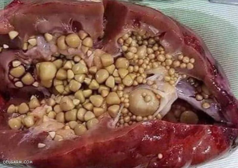 ایجاد سنگ کلیه از عوارض گل محمدی