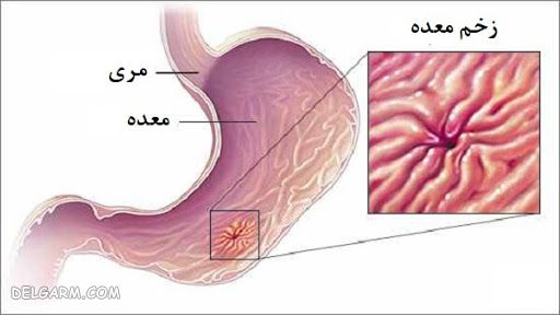 درمان خانگی با سیب زمینی
