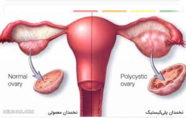 درمان تخمدان پلی کیستیک در طب سنتی