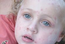 آنتی هیستامین،داروی ضدخارش آبله مرغان(chickenpox) (2 نکته مهم)