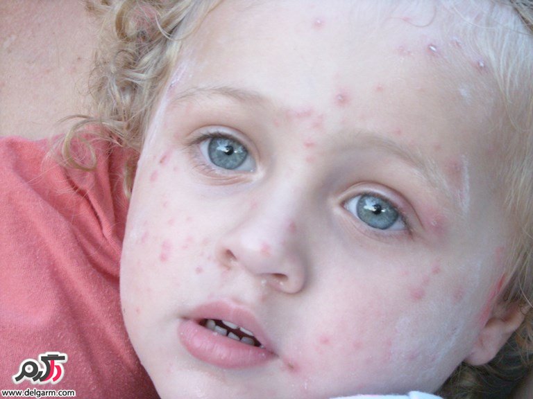 آنتی هیستامین،داروی ضدخارش آبله مرغان(chickenpox) (2 نکته مهم)
