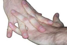 آیا شکستن انگشتان مضر است؟ (2 نکته مهم)