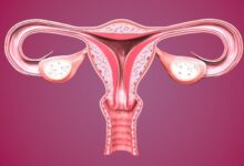 آیا میدانید تفاوت تخمدان پلی کیستیک و تنبلی تخمدان در چیست ؟ (2 نکته مهم)