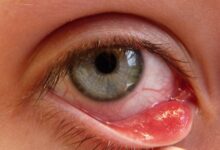 بیماری اکتروپیون چیست و چه علائمی دارد؟ (2 نکته مهم)