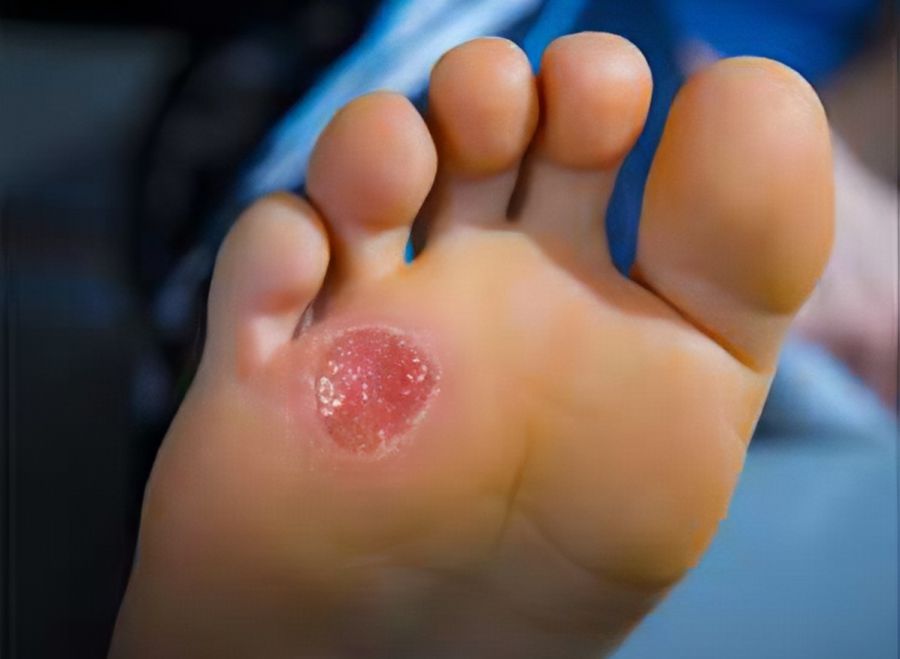 تاول دیابتی چیست؟ (2 نکته مهم) تاول دیابتی چیست؟ (2 نکته مهم)