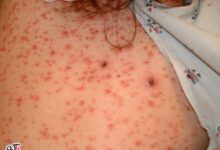 تشخیص و درمان بیماری سیفلیس( سفلیس ( Syphilis)) (2 نکته مهم)