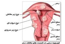 خانمها درباره کیست های خوش خیم وبدخیم رحم چه میدانید؟ (2 نکته مهم)