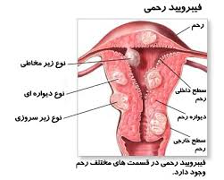 خانمها درباره کیست های خوش خیم وبدخیم رحم چه میدانید؟ (2 نکته مهم) خانمها درباره کیست های خوش خیم وبدخیم رحم چه میدانید؟ (2 نکته مهم)
