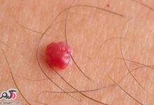 خطرات آنژیوم(خال های قرمز)روی بدن چیست؟ (2 نکته مهم)