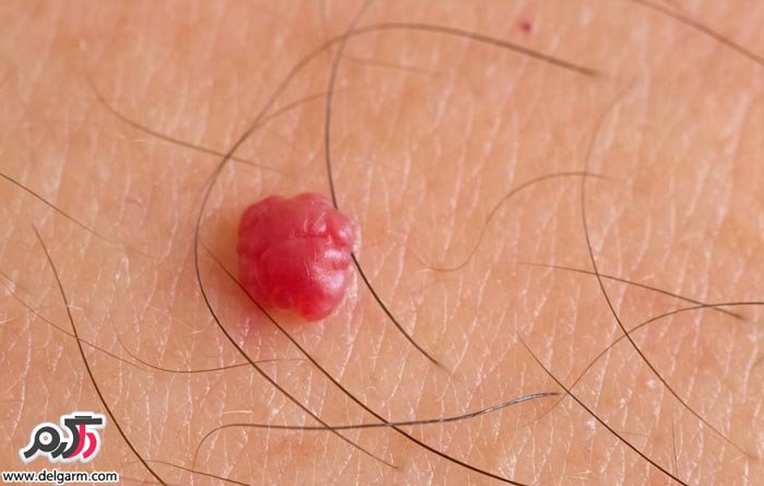 خطرات آنژیوم(خال های قرمز)روی بدن چیست؟ (2 نکته مهم) خطرات آنژیوم(خال های قرمز)روی بدن چیست؟ (2 نکته مهم)