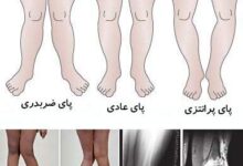 درمان پاهای پرانتزی و ضربدری (2 نکته مهم)