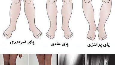 درمان پاهای پرانتزی و ضربدری (2 نکته مهم)