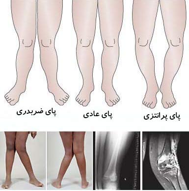 درمان پاهای پرانتزی و ضربدری (2 نکته مهم)