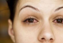 سودوتومور اربیت چشم چیست و چه علائمی دارد؟ (2 نکته مهم)