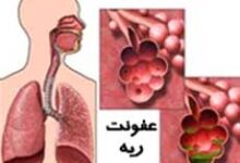 عفونت ریه و چند نمونه از بیماری‌های آن (2 نکته مهم)