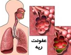 عفونت ریه و چند نمونه از بیماری‌های آن (2 نکته مهم)