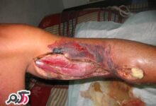 علائم بیماری سیاه زخم Anthrax ،Charbon (2 نکته مهم)