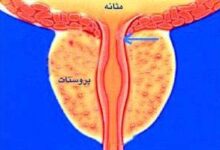 علائم هشدار دهنده پروستات بزرگ (2 نکته مهم)