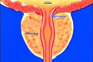علائم هشدار دهنده پروستات بزرگ (2 نکته مهم) علائم هشدار دهنده پروستات بزرگ (2 نکته مهم)