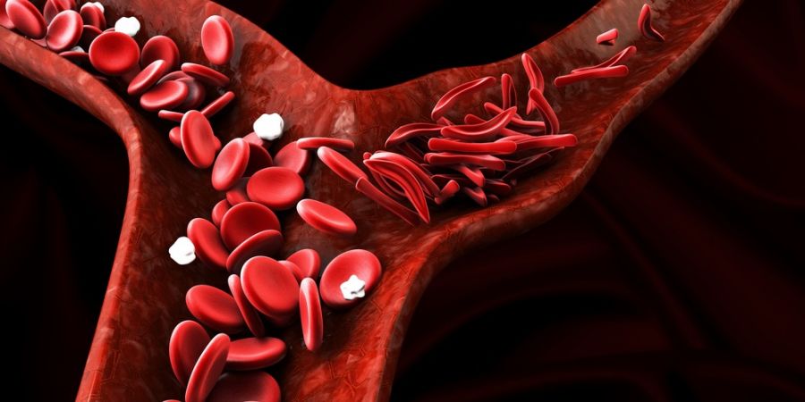 علائم کم خونی داسی شکل چیست و چگونه درمان میشود ؟ (2 نکته مهم) علائم کم خونی داسی شکل چیست و چگونه درمان میشود ؟ (2 نکته مهم)