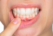 علت بیماری جینجیویت چیست؟ (2 نکته مهم)