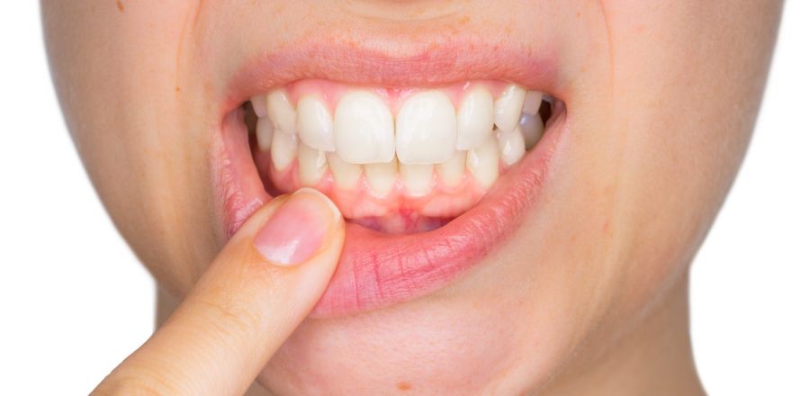 علت بیماری جینجیویت چیست؟ (2 نکته مهم)
