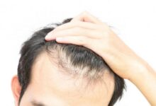علت ریزش مو پس از عمل چیست؟ (2 نکته مهم)