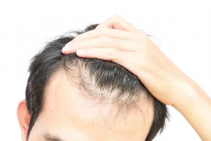علت ریزش مو پس از عمل چیست؟ (2 نکته مهم) علت ریزش مو پس از عمل چیست؟ (2 نکته مهم)