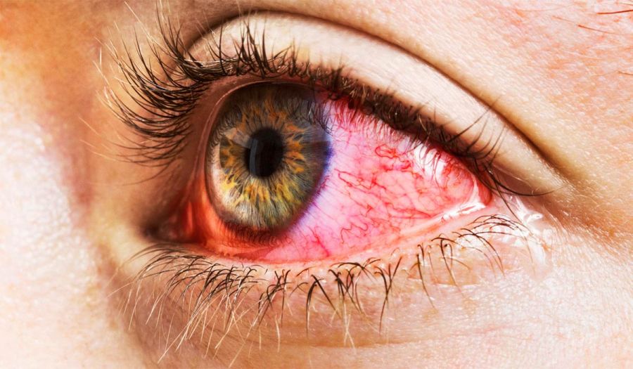 علت قرمزی مداوم مویرگ های چشم چیست؟ (2 نکته مهم) علت قرمزی مداوم مویرگ های چشم چیست؟ (2 نکته مهم)