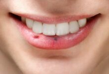 علت لکه و خال سیاه روی لب چیست؟ (2 نکته مهم)