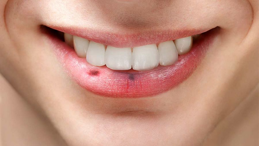 علت لکه و خال سیاه روی لب چیست؟ (2 نکته مهم)