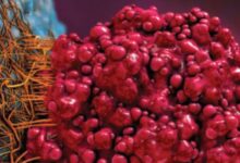 متاستاز (Metastasis) چیست و کدام قسمت بدن را درگیر میکند ؟ (2 نکته مهم)