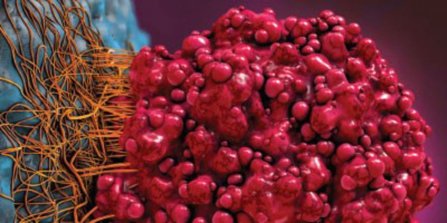 متاستاز (Metastasis) چیست و کدام قسمت بدن را درگیر میکند ؟ (2 نکته مهم) متاستاز (Metastasis) چیست و کدام قسمت بدن را درگیر میکند ؟ (2 نکته مهم)