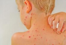 نشانه های سندرم رای و بهترین راه درمان این بیماری کدام است؟ (2 نکته مهم)