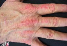 همه چیز در مورد درماتومیوزیت (Dermatomyositis) (2 نکته مهم)