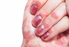 همه چیز درباره اگزمای پوست دست خانم ها (2 نکته مهم)