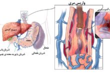 واریس مری چیست؟ + بهترین راه درمان واریس مری (2 نکته مهم)