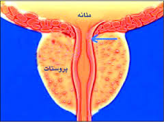 پروستات چیست؟ (2 نکته مهم) پروستات چیست؟ (2 نکته مهم)