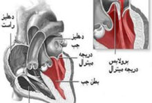 پرولاپس(افتادگی)دریچه قلب:علل،علائم و عوارض آن (2 نکته مهم)